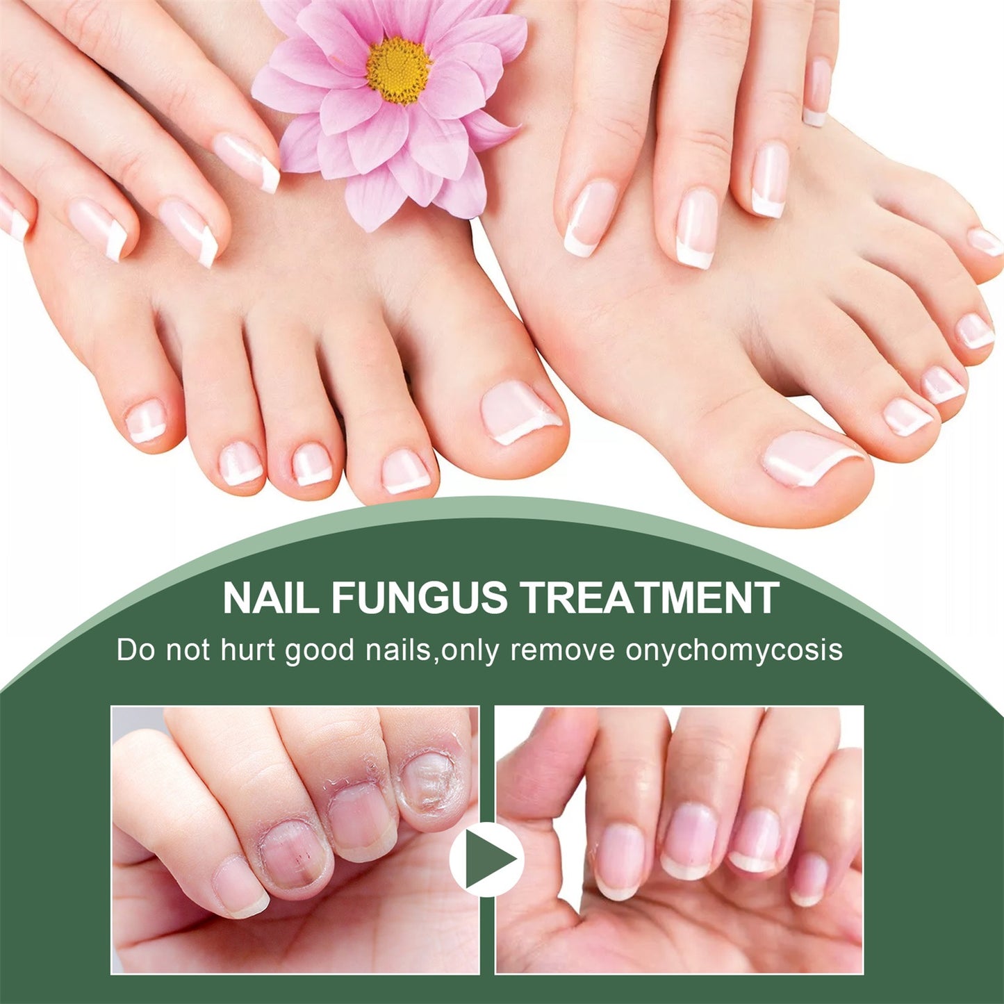 Anti-Fungus Nail Treatment