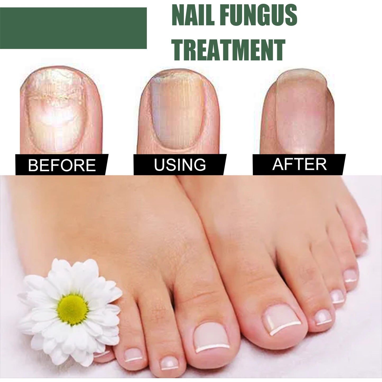 Anti-Fungus Nail Treatment
