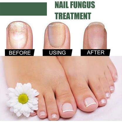 Anti-Fungus Nail Treatment