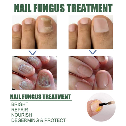 Anti-Fungus Nail Treatment