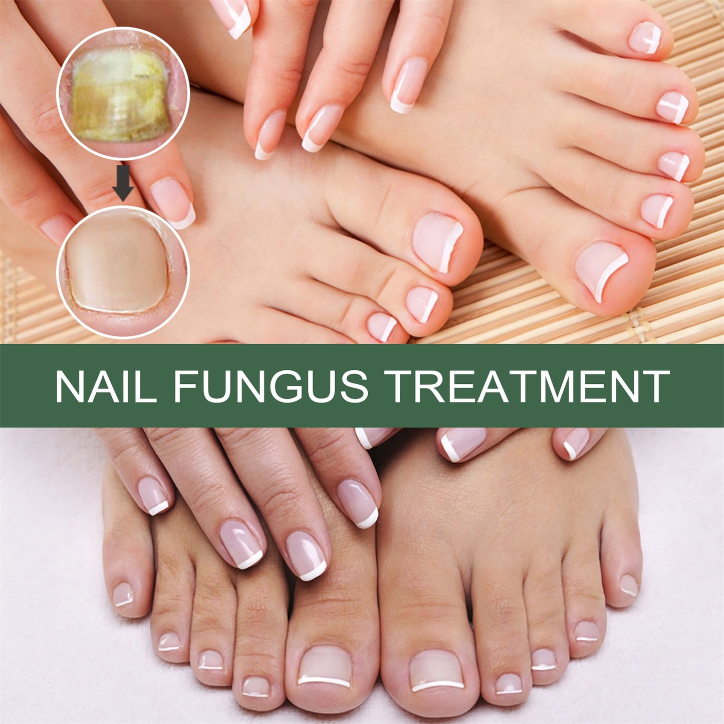 Anti-Fungus Nail Treatment