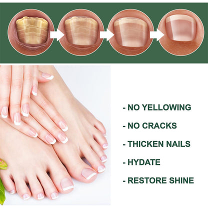 Anti-Fungus Nail Treatment